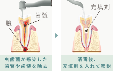 虫歯菌が感染した歯質や歯髄を除去し、消毒後充填剤を入れて密封