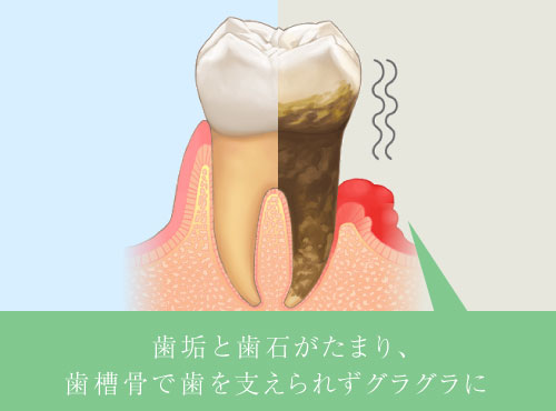 歯垢と歯石がたまり、歯槽骨で歯を支えられずグラグラに
