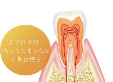 まずは予防！なってしまったら早期治療を