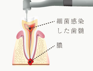 細菌感染した歯髄