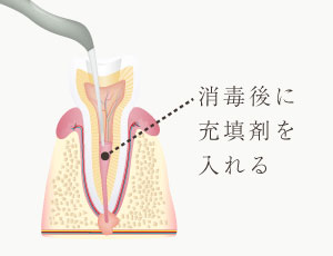 消毒後に充填剤を入れる