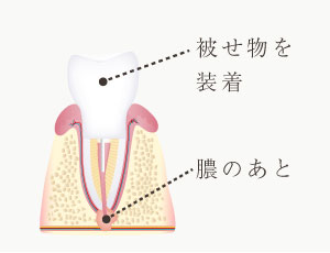 被せ物を装着