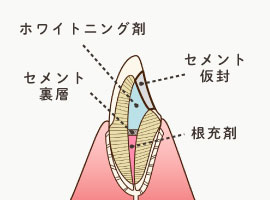 ウォーキングブリーチ